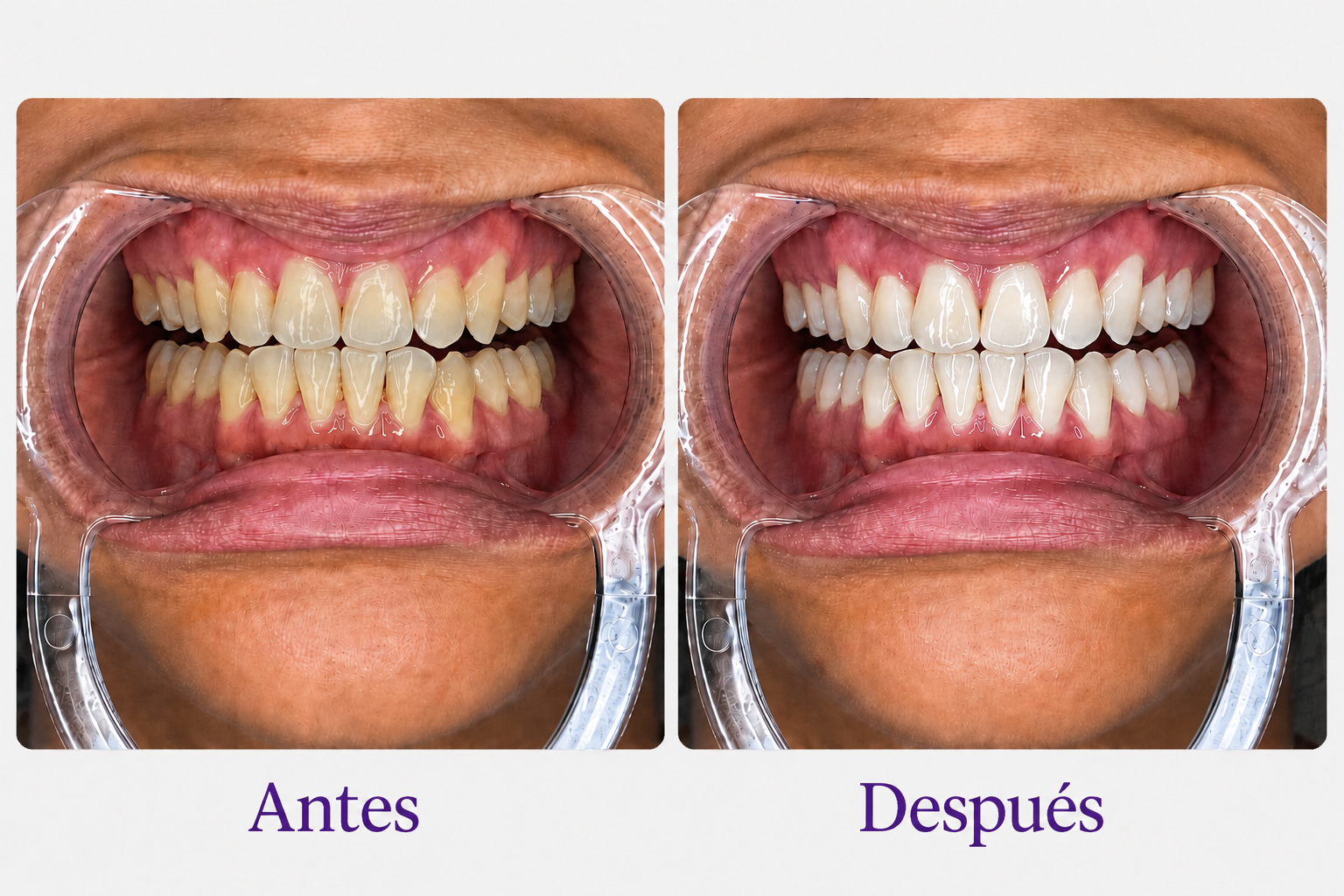 Antes y después del uso de Ivoria